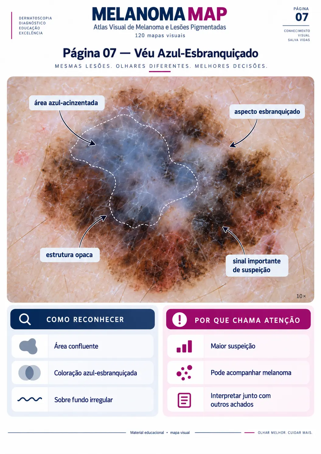 Página do MELANOMA MAP: Véu Azul-Esbranquiçado